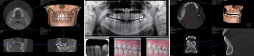歯科用3D（立体）デジタルCT